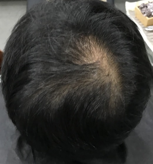 樹脂針微細ドット1次体験談