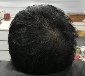 &lt;시술 후&gt; 