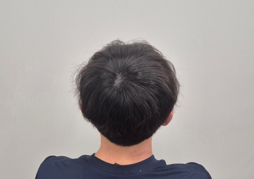 시술 바로 직후