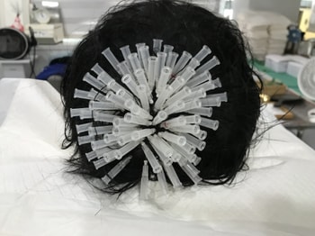 잔머리 재생술 치료 사진