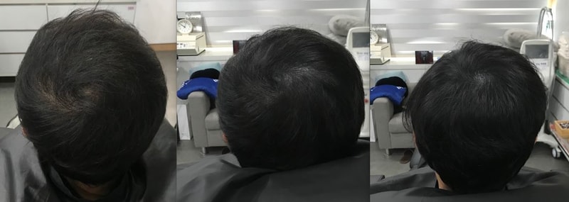 修复及碎发再生术治疗后记