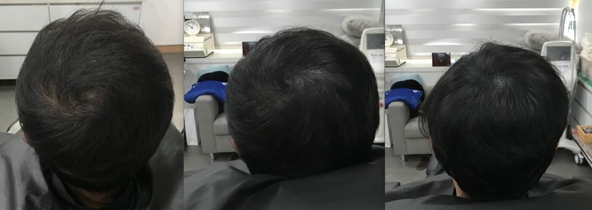 좌 : 시술 전 | 중 : 리터치 전 | 우 : 리터치 및 잔머리 재생술 후