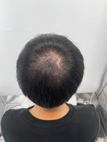 시술 전
