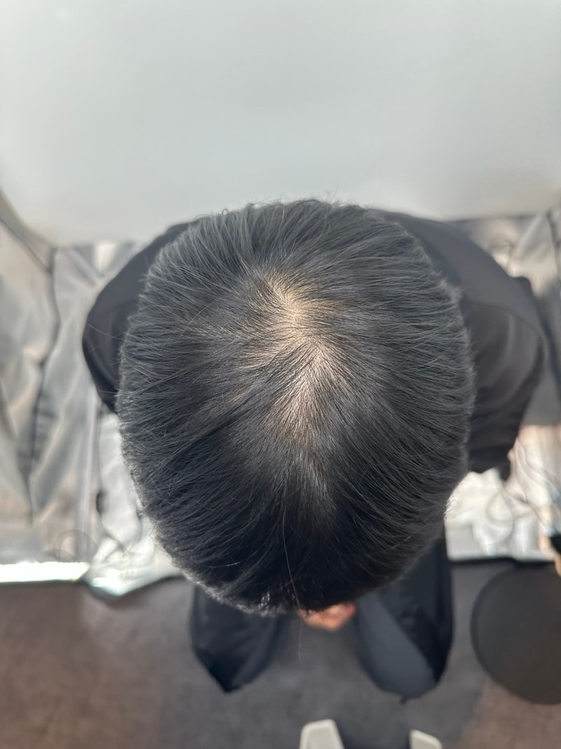 ニューヘア毛髪整形外科の頭皮タトゥー7日目の体験談です