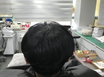 두피문신후 사진2
