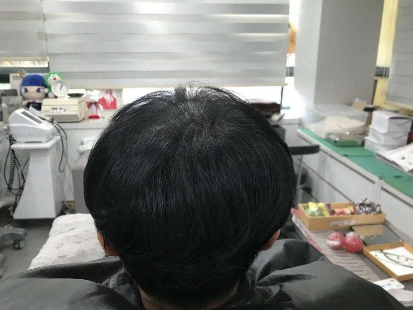 두피문신후 사진2