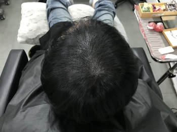 두피문신후 사진1