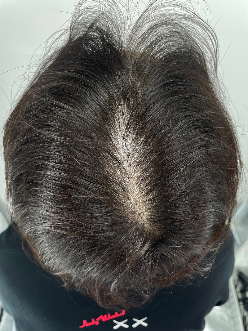 頭皮タトゥー効果施術体験談です。 最強ニューヘア江南店フフ