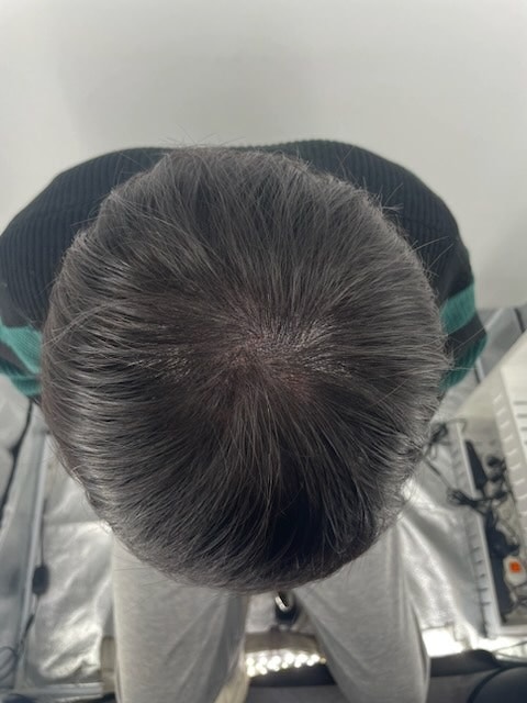 江南ニューヘア頭皮タトゥー体験談 完全満足です