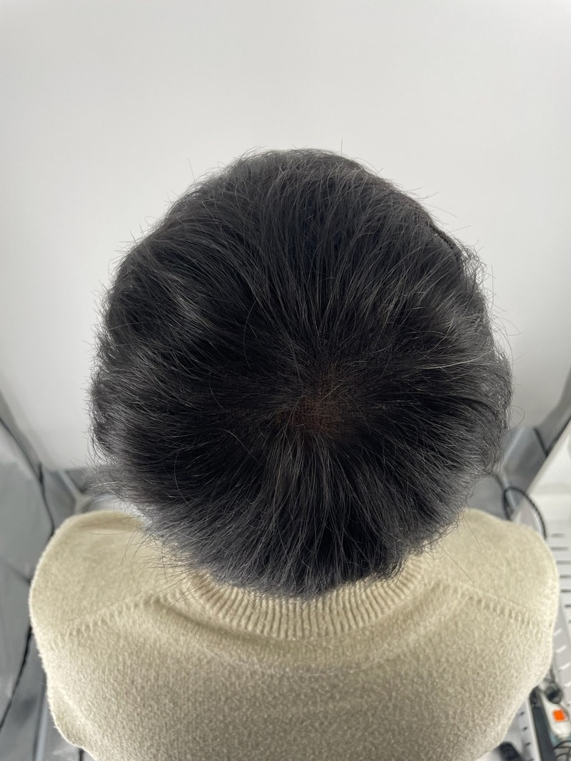 강남에서 두피문신 받으세요! 뉴헤어모발성형외과로 오세요!