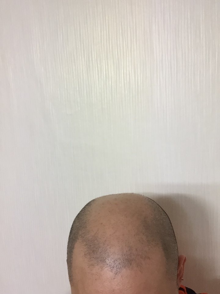 DMP 手术后记 [第三弹]