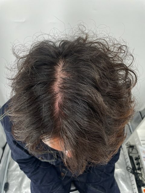 두피문신3차후기 만족합니다! 뉴헤어가 믿을 만합니다