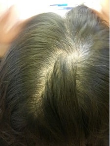 두피문신 그동안 마음고생 모두 안녕.