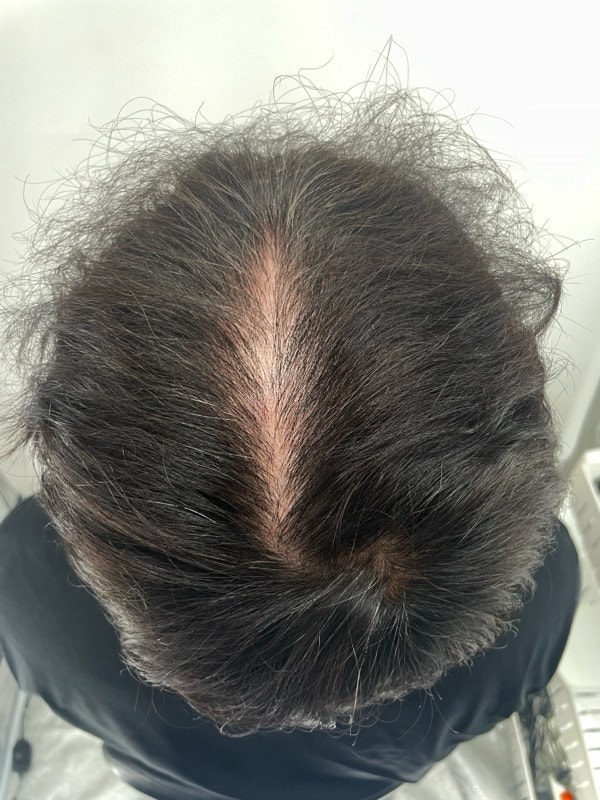 江南新发头皮纹身后记。