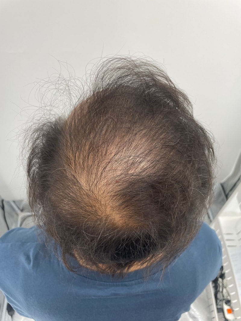 강남 정수리 타투 뉴헤어모발성형외과에서 했습니다! 대만족