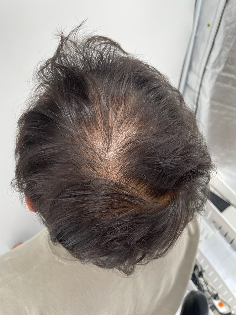 뉴헤어에서 두피문신 했어요. 빨리 할걸 ㅠ 고민하지마세요~