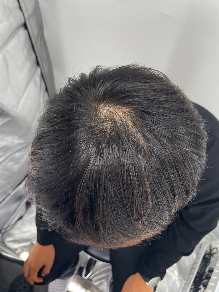 강남 뉴헤어 모발성형외과 두피문신 추천합니다 아주 베리굿~~~