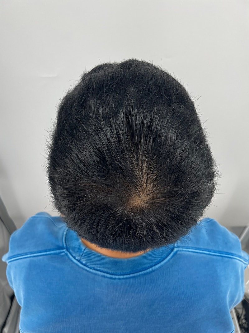 강남 두피문신 시술 받았어요. 뉴헤어모발성형외과 추천!