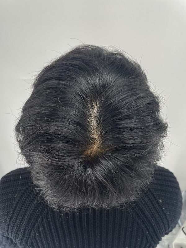 I got a hair loss tattoo from New Hair