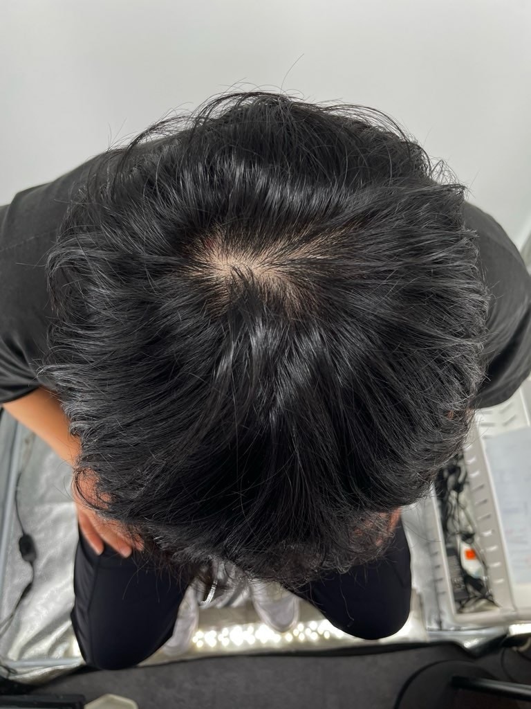 강남뉴헤어에서 두피문신 시술 받았습니다.