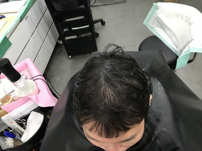 1st touch of the top of the scalp tattoo and the 1st addition of the frontal head