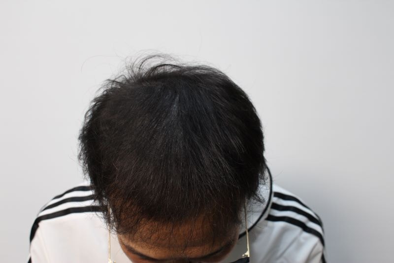 대전두피문신 리즈모의원에서 시술 후에는 두피가 어두워져 제가 보기에는 너무 좋아진거 같았습니다.