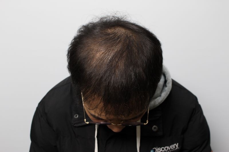 대전리즈모의원 두피문신 후기 올려봅니다.