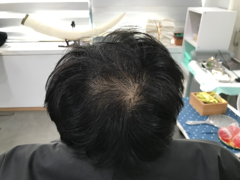 시술 받기전 사진입니다 !