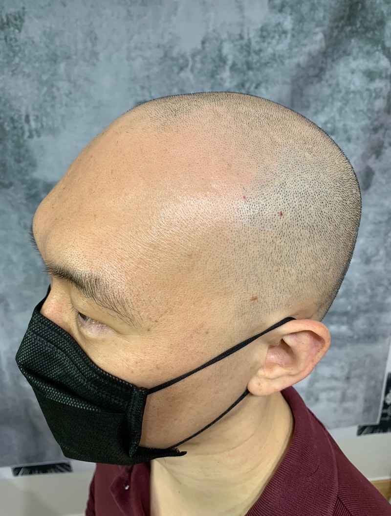 두피문신 솔직후기