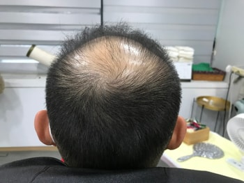 시술전2
