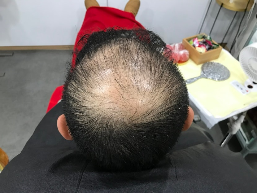 시술전