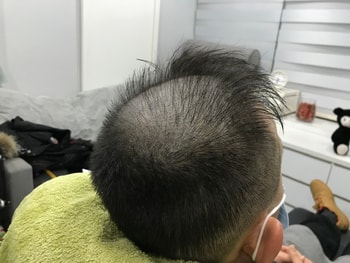1차 시술후2