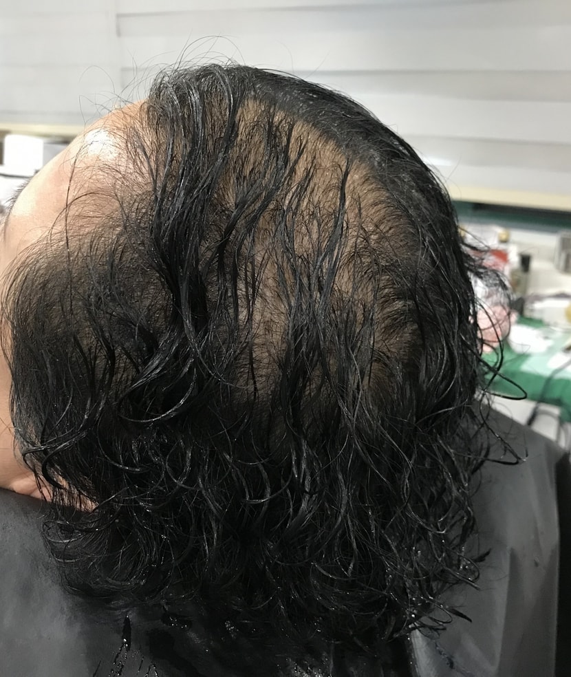 시술전(젖은 상태)