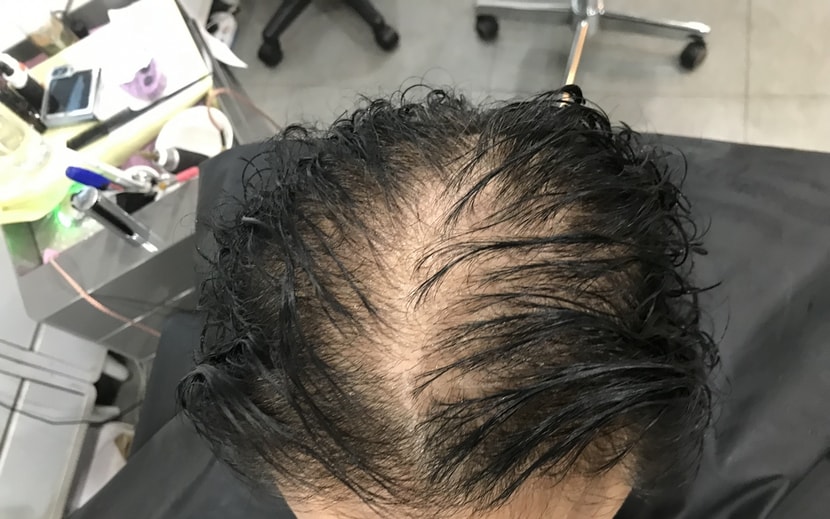 시술전(젖은 상태)