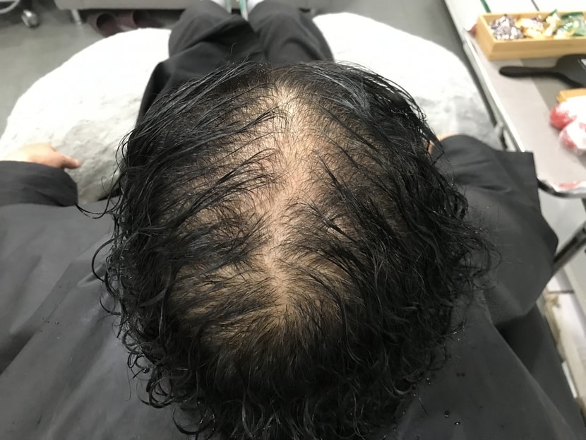 시술전(젖은 상태)