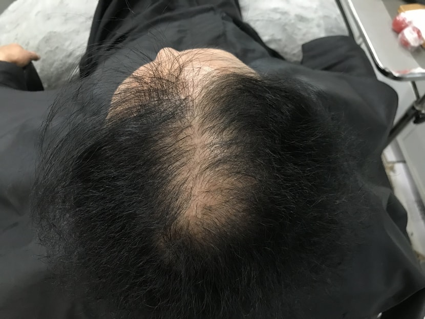 시술전