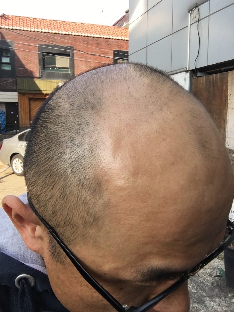 是光头皮纹身后记^^