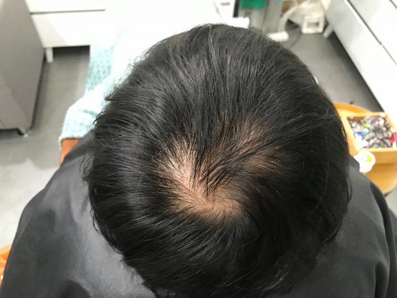 심사숙고 끝에 두피문신을 했습니다