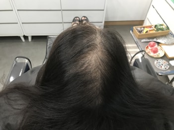 시술전1