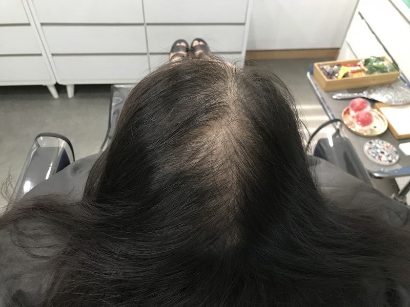 두피문신 매우만족!!