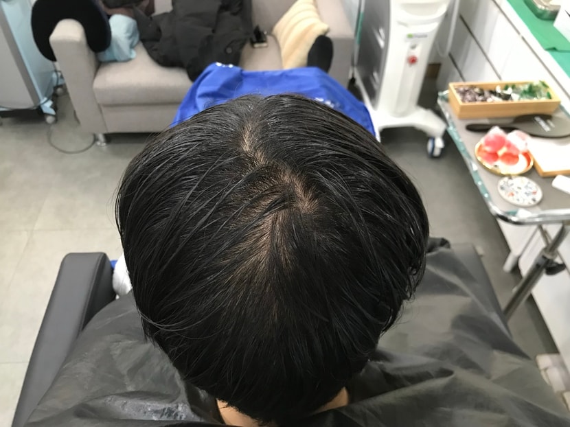 시술 전