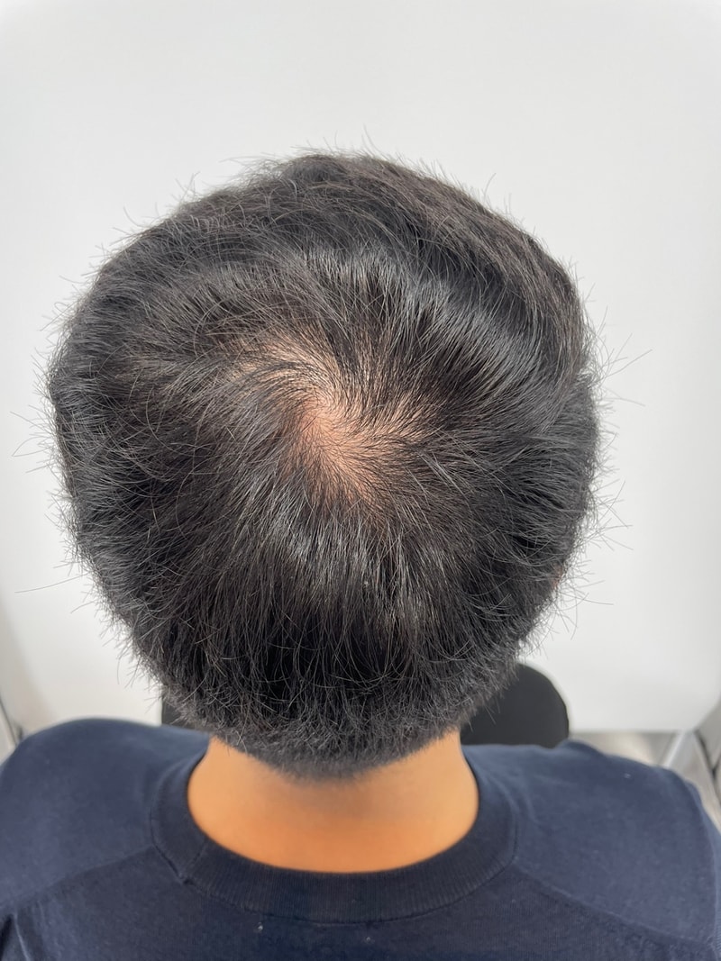 頭皮タトゥー後記