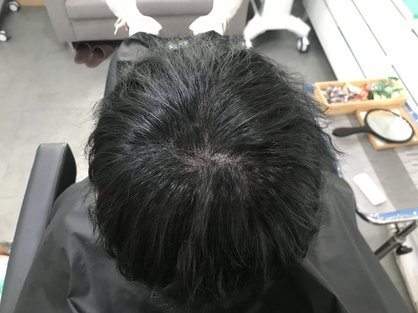 시술 후