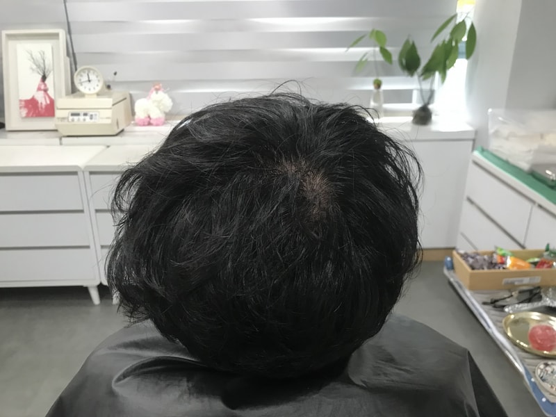 [ヨンセミダイン] 頭皮タトゥーの体験談です。