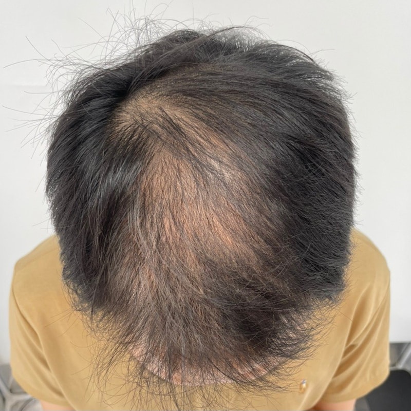 SMP頭皮タトゥー2回目の体験談 （チョンスリ、ニューヘアソウル）