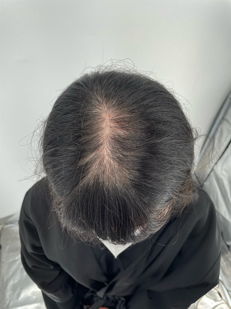 뉴헤어 서울점 두피문신 3차까지 받았습니다