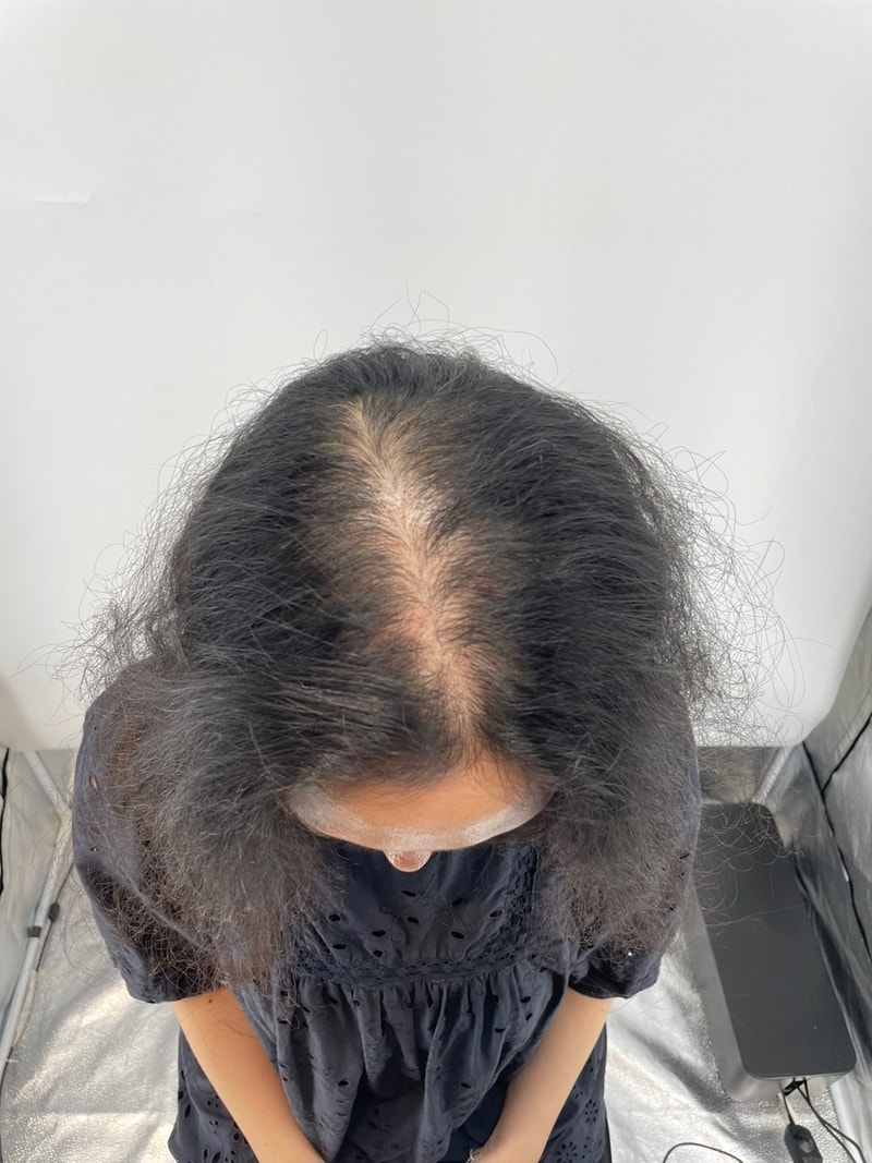 New Hair首尔店 SMP 头皮纹身 第二集后记