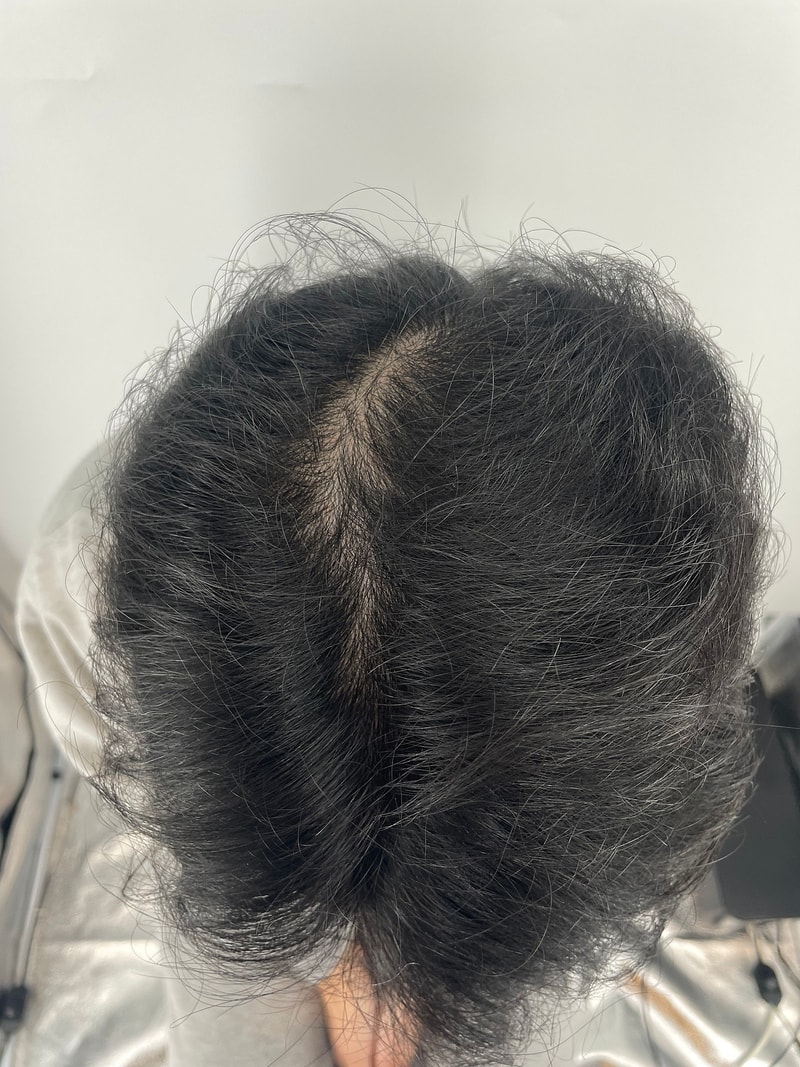 뉴헤어 서울점에서 정수리 SMP 했습니다.