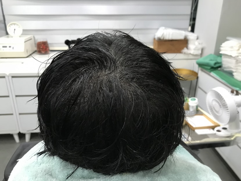 수술 후