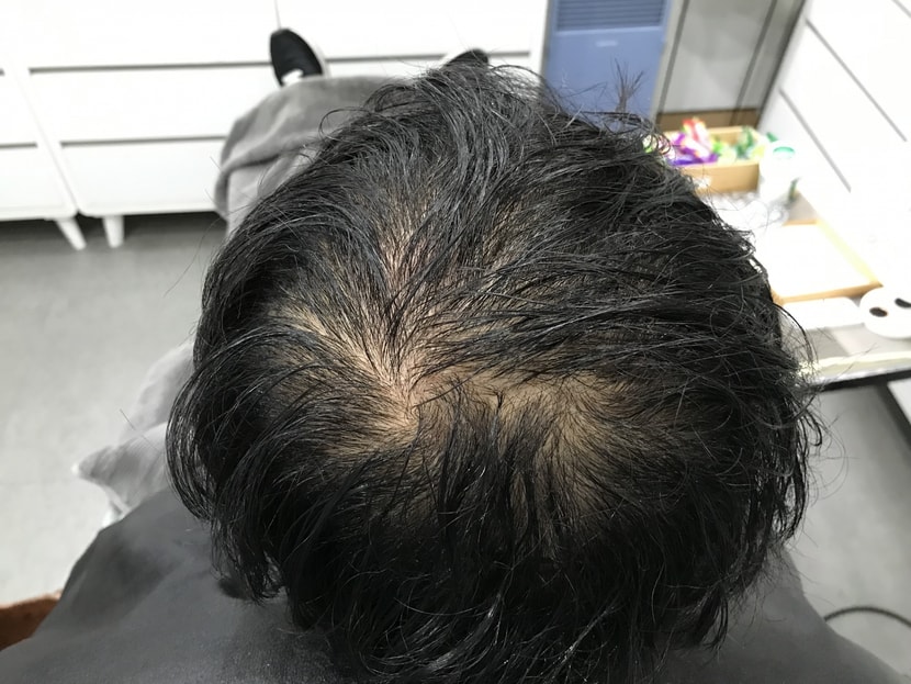 수술 전